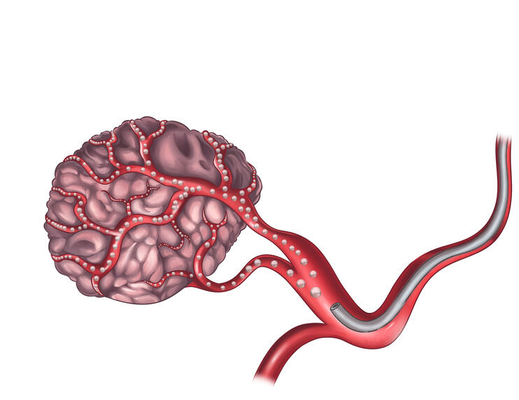 Uterine Fibroid Embolization
