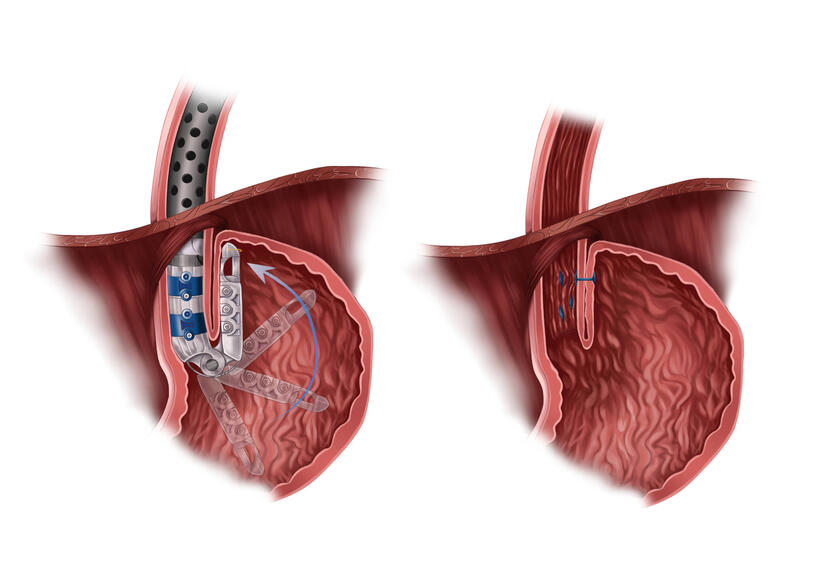 TIF Procedure Demonstration